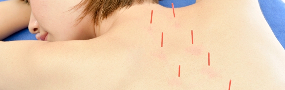 鍼灸　鍼　鍼灸院